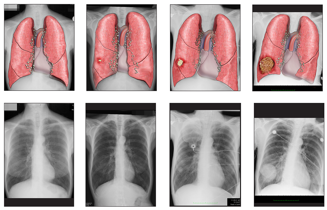 radiographic presentation of lung cancer